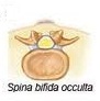 Spina bifida occuta (Спина бифида акута)